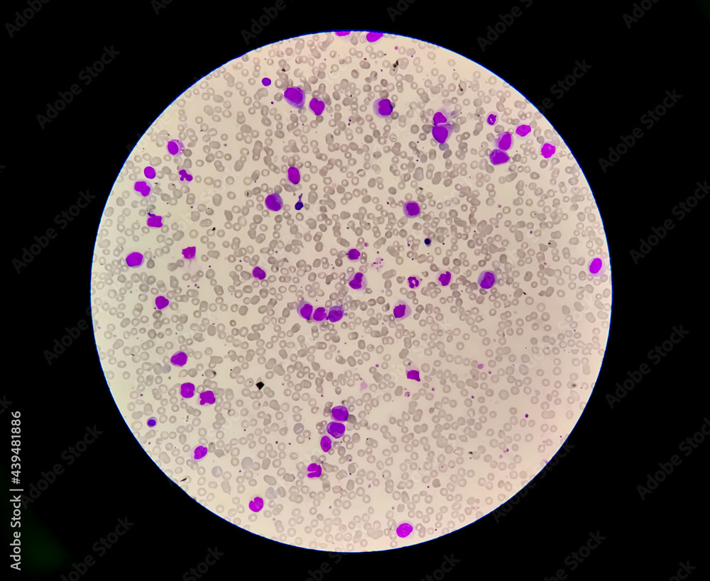 Microscopic view of cold agglutinin disease (CAD), autoimmune hemolytic ...