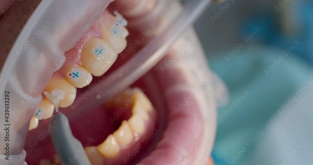 Closeup open mouth with optragate and on teeth are braces that