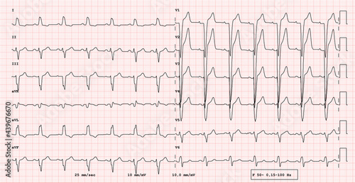 Foto ECG example of  12-lead rhythm,  left bundle branch block, real exam