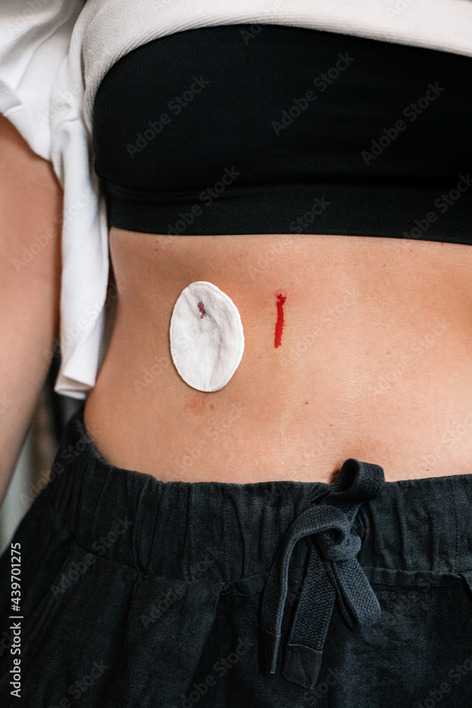 Hirudotherapy wounds covered with cotton pads Stock Photo Adobe Stock