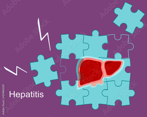 Concept of hepatitis A,B,C,D, cirrhosis.Fragile and broken liver falls apart by puzzles.World hepatitis day. Organ care. Vaccinate, treat, test. Vector in flat style. Medical banner.
