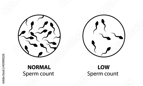Spermogram. The number of spermatozoa photo