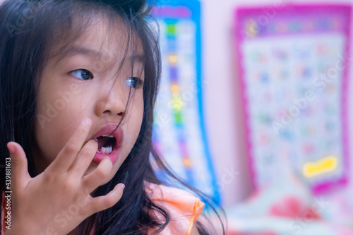 A 5-year-old Asian girl broke her first tooth.