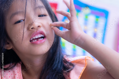 A 5-year-old Asian girl broke her first tooth.