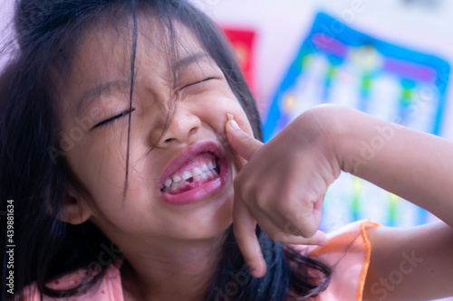 A 5-year-old Asian girl broke her first tooth.