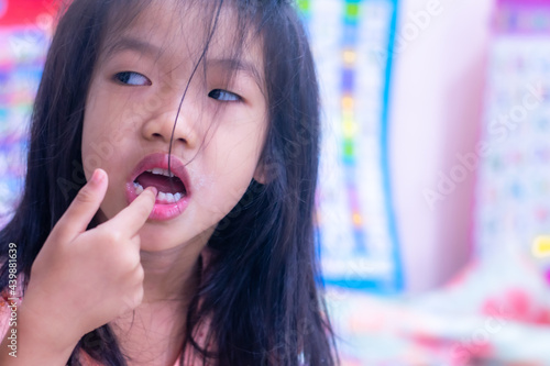 A 5-year-old Asian girl broke her first tooth.
