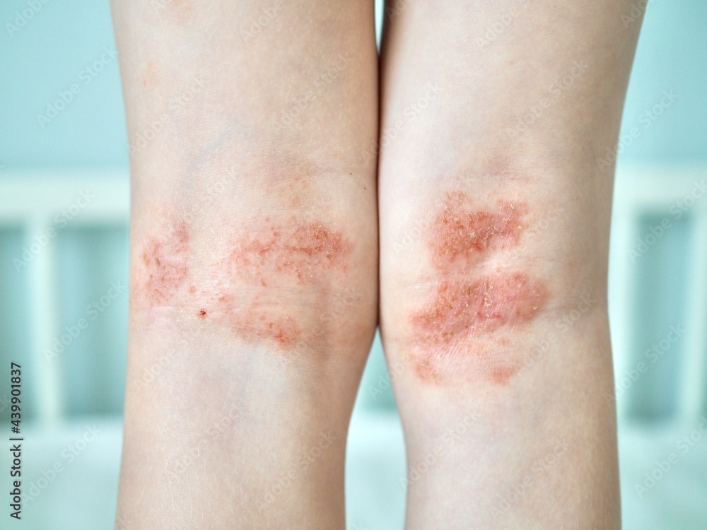 Eczema on kid's legs. Atopic dermatitis close up. Allergy spots and red