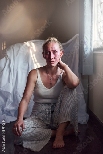 Portrait of a young woman with a red facial birthmark on the flo