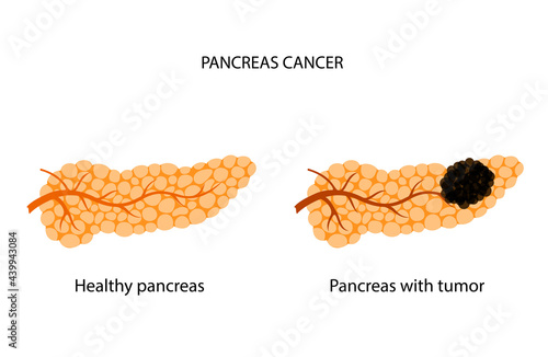 Pancreas disease and cancer