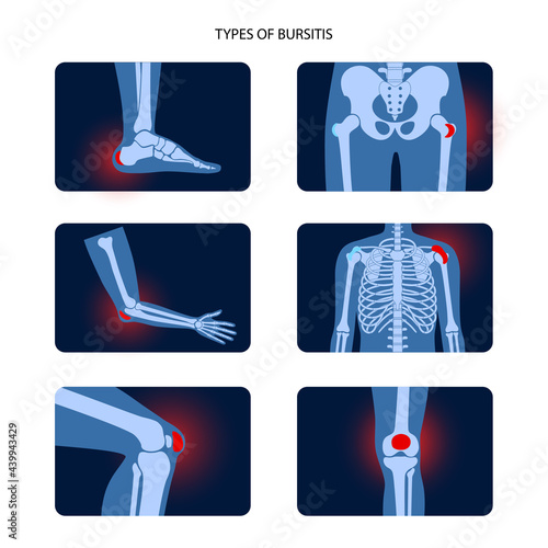 Bursitis icons set