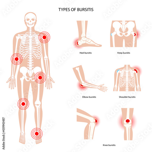 Bursitis icons set