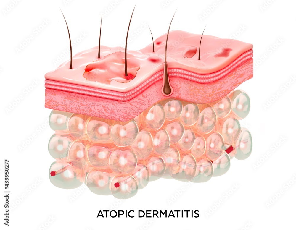 Eczema. 3d illustration of the crosssection of skin layers with atopic