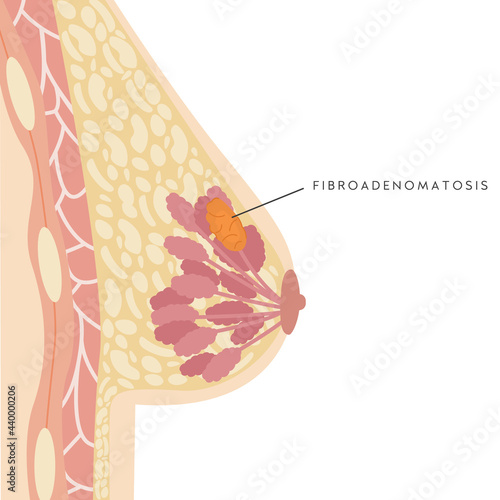 Medical Infographic Cross Section of Female Breast with Fibroadenomatosis. Information card with benign breast lesion. Fibroadenoma. Anatomy of Woman Chest. Mammary gland. Vector illustration.