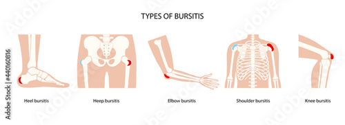 Bursitis icons set