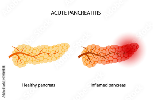 Pancreas disease and cancer