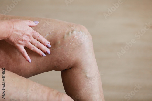 The woman rubs tired legs with a special cream to reduce pain. Phlebology. Painful varicose and spider veins on active female legs, medicine and health.