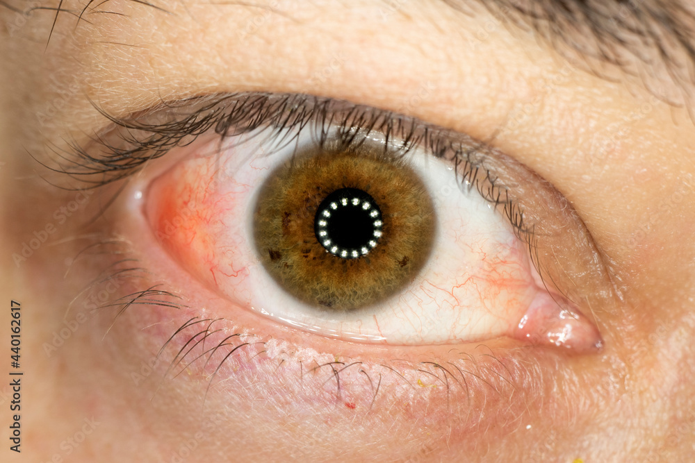 irritated eye, irritated eye from scleritis, redness of the sclera, inflammation in the white part of the eye. irritated eye, irritated eye from scleritis, redness of the sclera, inflammation in the white part of the eye.
