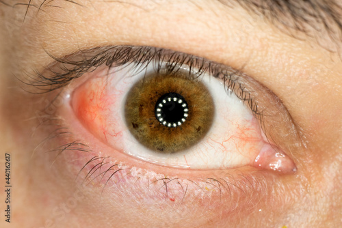 irritated eye, irritated eye from scleritis, redness of the sclera, inflammation in the white part of the eye. photo
