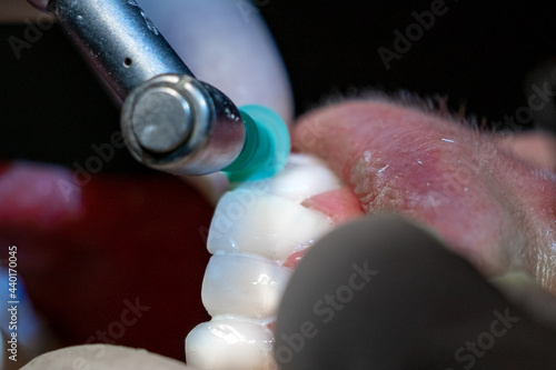 Polishing teeth, dental hygiene. 