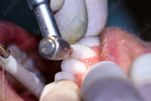 Polishing of teeth,  dental hygiene. 