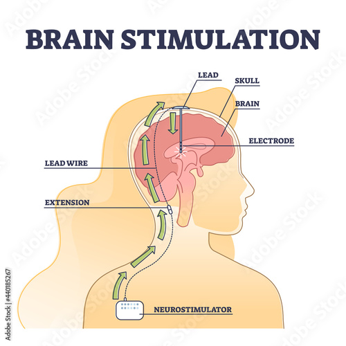 Deep brain stimulation procedure educational explanation outline diagram. DBS process example with head surgical neurostimulator electrodes implantation vector illustration. Disorders treatment scheme