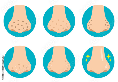 鼻の毛穴の汚れのイラストアイコン　フラットデザイン　アイコン　Blackheads on the nose