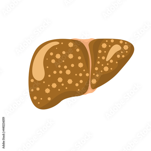 Stages liver damage set dd ww isol