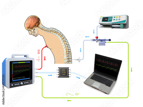 Lumbar Puncture or Spinal Tap Procedure Medical Poster with Human Vertebral Column and Syringe Needle Inserted Into Spinal Canal to Collect Cerebrospinal Fluid Anatomical Realistic, 2d, 3d