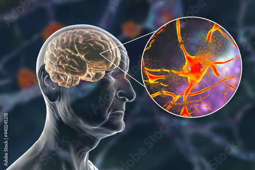 Dementia and Alzheimer's disease medical concept, 3D illustration. Memory loss, brain aging photo