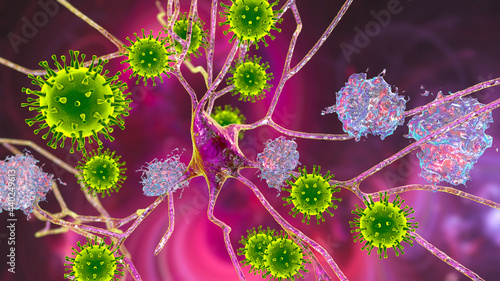 Принти на полотні Infectious etiology of dementia. Viruses that affect neurons