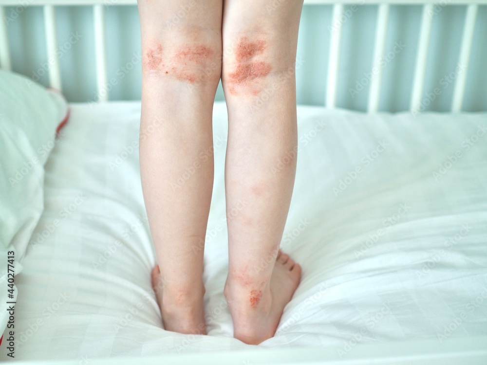 Eczema on kid's legs. Atopic dermatitis close up. Allergy spots and red ...