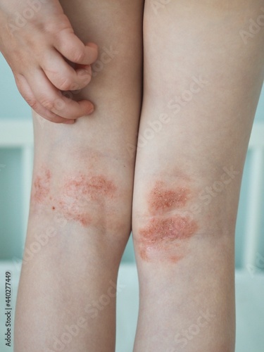 Atopic dermatitis close up. Allergy spots and red itchy skin inflammation on child's feet. Eczema on kid's legs