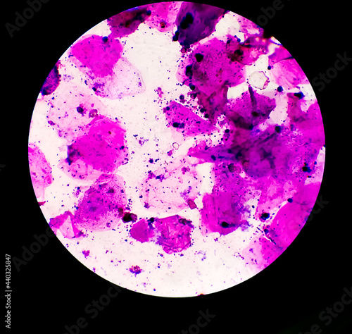 Urethral Smear or discharge microscopic show epithelial cells and Gram-positive cocci include Staphylococcus aureus which is causes for infection of patients. 100x objective.Closeup photo