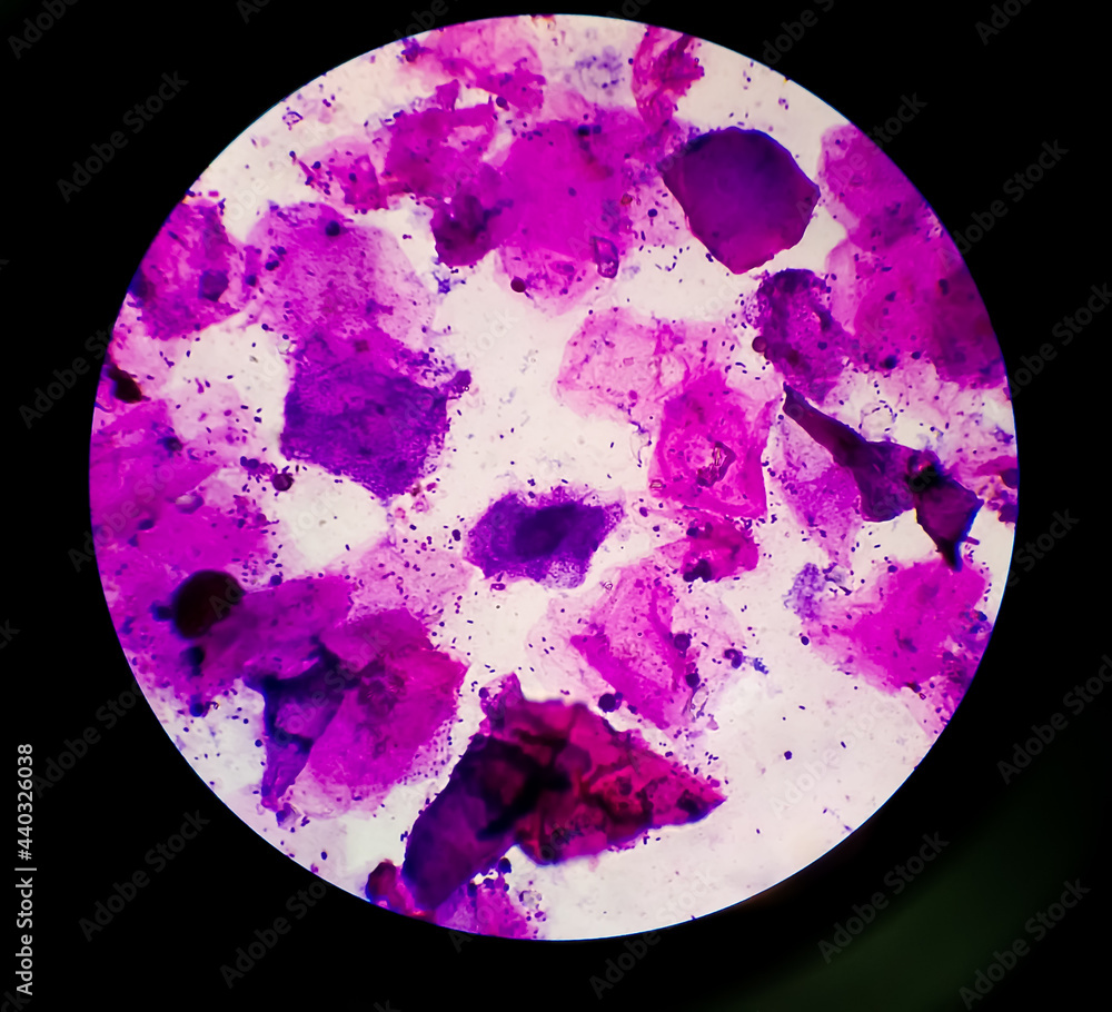 Urethral Smear or discharge microscopic show epithelial cells and Gram