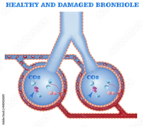 Gas exhange in alveolus with healthy and narrowed bronhiole, damaged airways, mecanical ventilation illustration