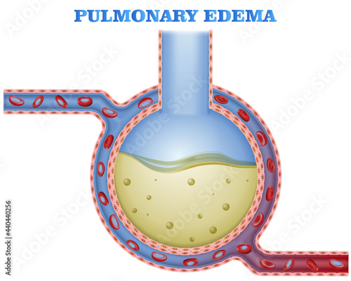 Alveoli filled with fluid, pulmonary edema, pneumonia, gas exhange during lung disease