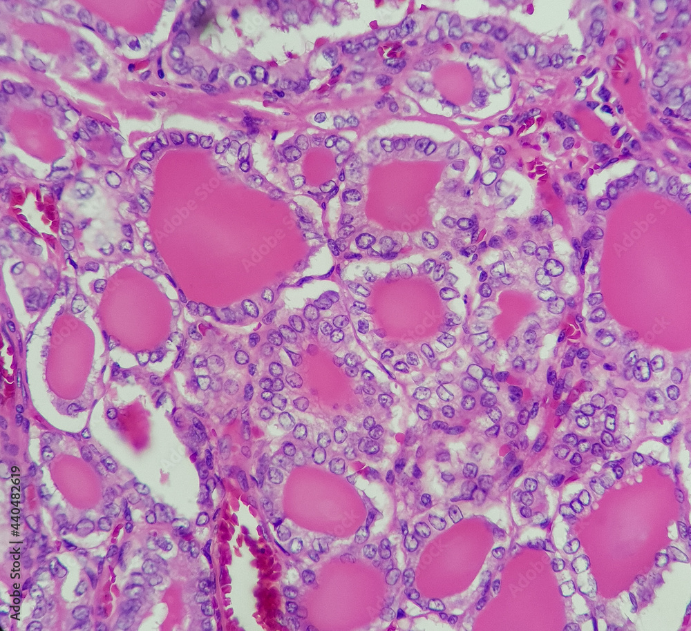Fototapeta premium Photo of papillary thyroid carcinoma, showing follicular pattern, magnification 400x, photo under microscope