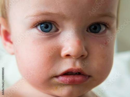 close-up of a child s face bitten by mosquitoes and stained with porridge