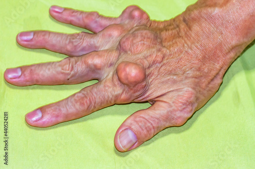 Old age and illnesses of pharmaceutical medicament severe gout in men suffering from joint pain, bone pain, gout ,arthritis ,arm, foot, knee, rheumatoid symptoms, Concept of abstract pain and despair