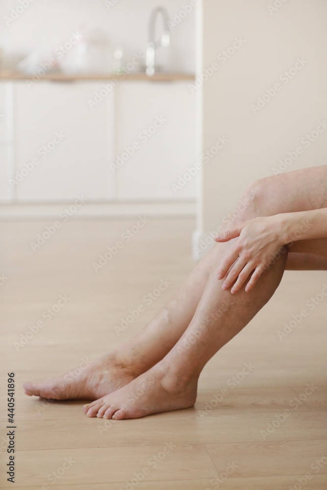 Painful varicose and spider veins on active womans legs, self-helping herself in overcoming the pain. Vascular disease, varicose veins problems, active life concept. Painful varicose and spider veins on active womans legs, self-helping herself in overcoming the pain. Vascular disease, varicose veins problems, active life concept.