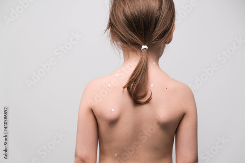 The back of a little girl with chickenpox smeared with white ointment on white background