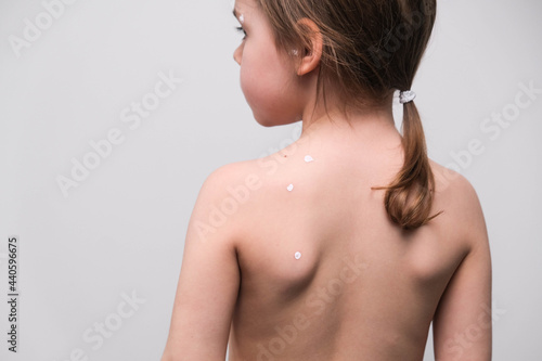 The back of a little girl with chickenpox smeared with white ointment on white background photo