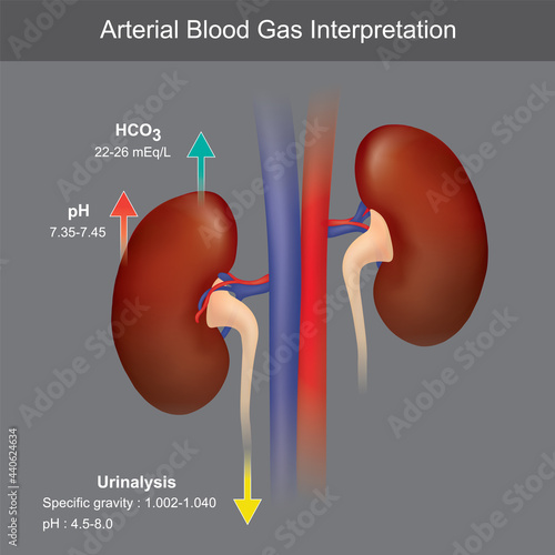 Arterial Blood Gas Interpretation photo