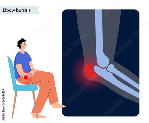 Student elbow bursitis