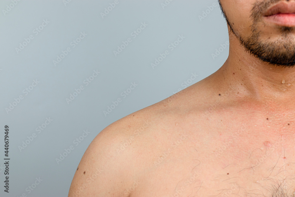 The man has beard and chest hair that sweat along his body. There are polyps on the neck and fleck on the body. The man has beard and chest hair that sweat along his body. There are polyps on the neck and fleck on the body.
