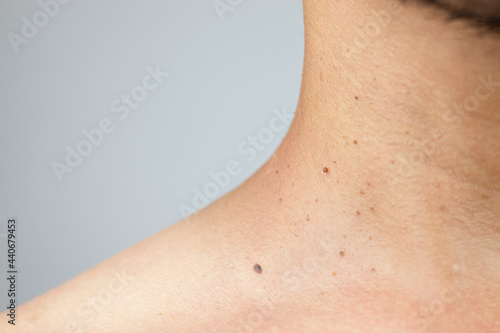 Close-up of a skin problem with polyps on the neck of a man.Pedunculated skin tag or acrochondon or soft fibroma.Papilloma bump on male body.Fibroepithelial polyp on stalk.Benign epidermis lesion clos