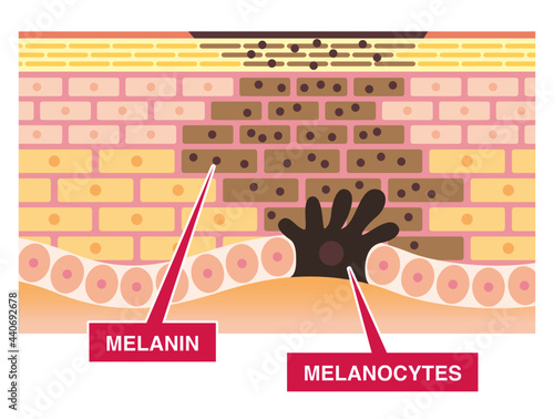 Spotted skin cross section. Melanin and melanocytes. Adverse effects of ultraviolet.  Pale colored illustration in flat cartoon style. photo