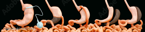 Types of Bariatric Surgery - 3D Rendering photo