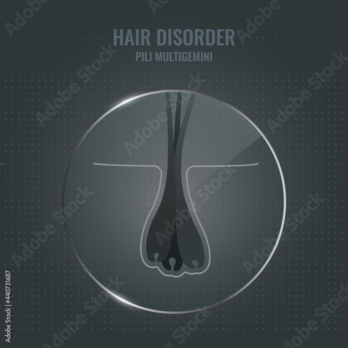 Pili multigemini hair disorder surface under microscope. Multiple hair shafts ingrowth condition closeup vector. Trichology medical concept.