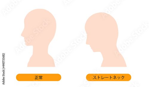 ストレートネック（スマホ首）と正常な首の骨のイメージ